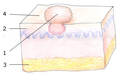 Схематическое изображение мягкой фибромы кожи