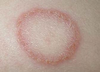 Симптомы микроспории (стригущего лишая) на коже