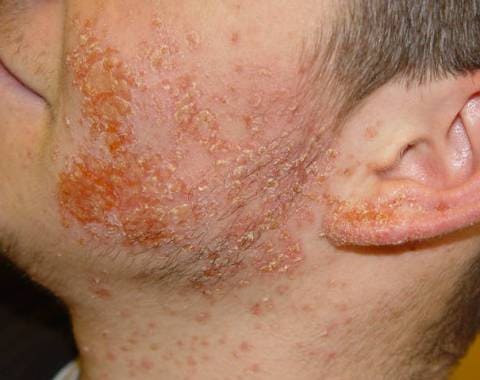Пиодермии (гнойничковые заболевания кожи)