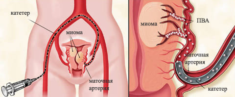 Эмболизация маточных артерий (ЭМА) при миоме матки