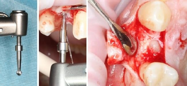 Имплантация зуба
