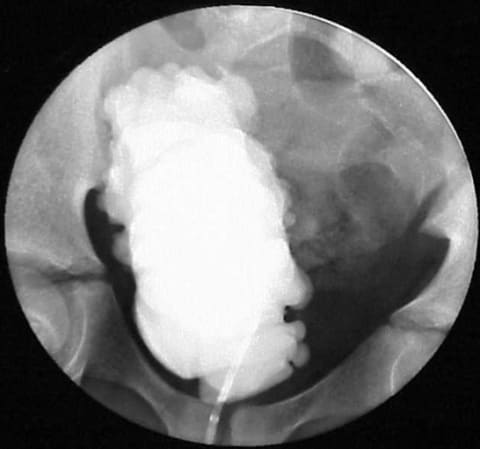 Нейрогенный мочевой пузырь при контрастной рентгенографии