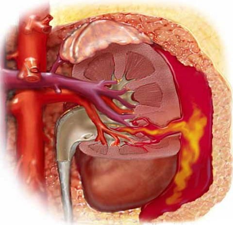 Травмы органов мочевыделительной системы (почек, мочевого пузыря, уретры)