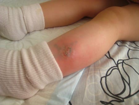 Аллергия на укус комара у ребенка