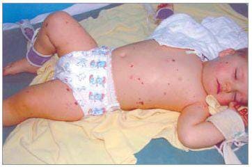 Менингококковый энцефаломиелит у ребенка