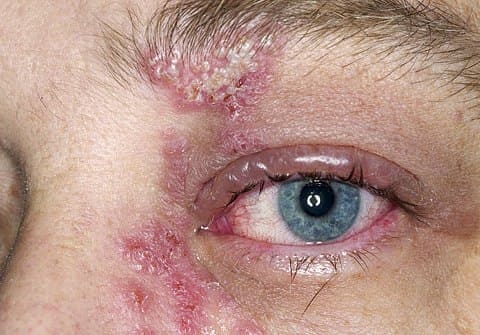 Симптомы герпеса на глазах
