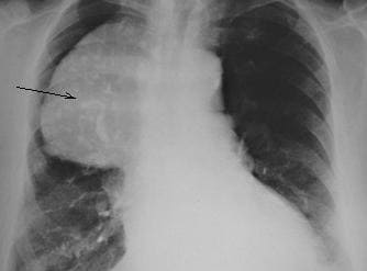 Рентгенограмма крупной опухоли средостения