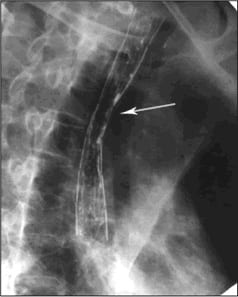 Рентгенограмма пищевода с контрастом