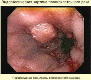 Эндоскопическая картина плоскоклеточного рака пищевода