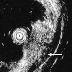 Ультразвуковая картинка опухоли пищевода, вид через гастроскоп