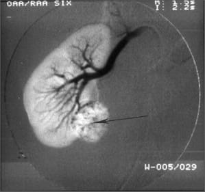 Ангиография. Стрелкой показана опухоль в нижнем полюсе почки, констрастирована почечная артерия