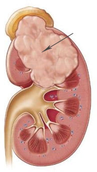 Схематичное изображение опухоли верхнего полюса почки с прорастанием в надпочечник и лоханку
