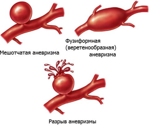 Аневризмы почечных артерий