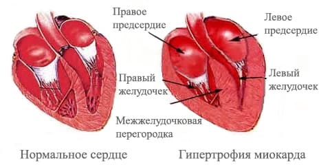 Гипертрофия левого желудочка сердца