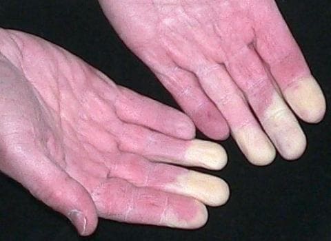 Побледнение пальцев кисти при феномене Рейно