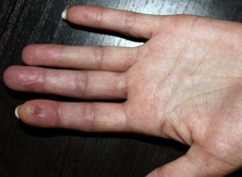 Язва конечной фаланги II пальца кисти при синдроме Рейно