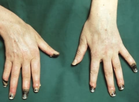Некрозы конечных фаланг пальцев кисти при синдроме Рейно