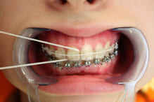 Использование суперфлоса для очистки промежутков между зубами