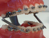 Брекеты на вестибулярной поверхности зубов