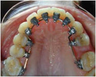 Брекеты на оральной поверхности зубов