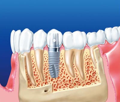 Вид имплантата в кости нижней челюсти