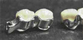 Элемент аттачмена на коронке опорного зуба
