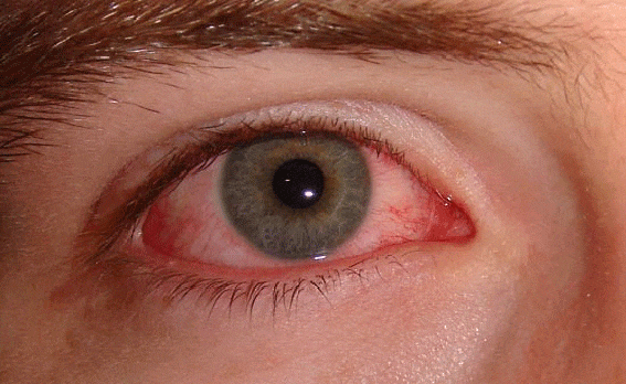 Фото Симптомы аллергического конъюнктивита. Покраснение глаз