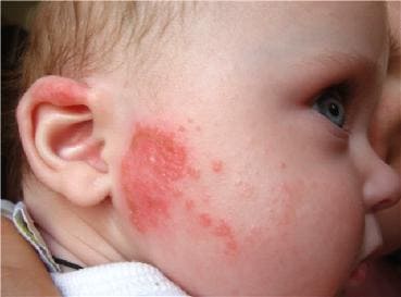 Аллергия, симптомы и лечение аллергии