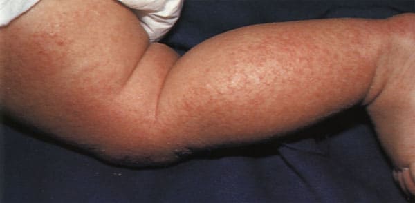 фото младенческая форма атопического дерматита симптомы