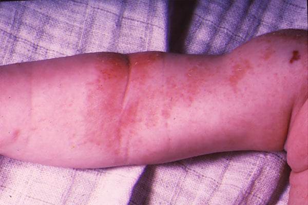 Фото детская форма атопического дерматита, симптомы