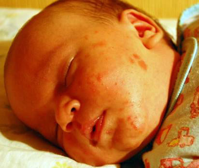 Фото аллергии у детей до года симптомы диатеза / атопический дерматит