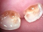 Кариес молочных зубов у детей раннего возраста фото