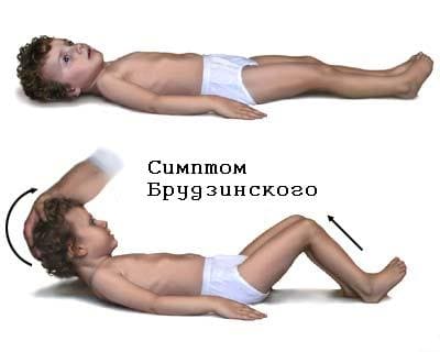 симптом Брудзинского (при попытке наклонить голову вперед в положении лежа ноги сгибаются в коленях, при надавливании на лобок ноги сгибаются в коленных суставах)
