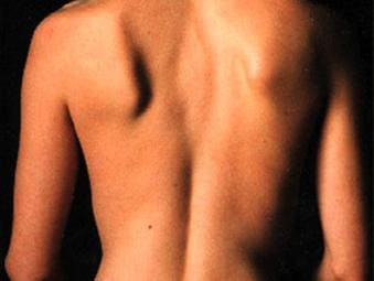 Атрофия мышц спины больного миопатией Ландузи – Дежерина