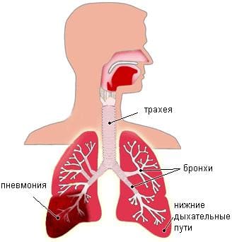 Симптомы и лечение пневмонии, пневмония у детей и взрослых