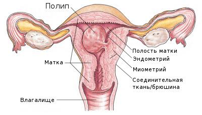 Полипоз эндометрия. Большой полип эндометрия