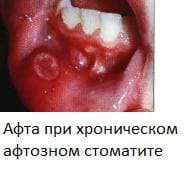 Стоматит воспаление полости рта симптомы с фото