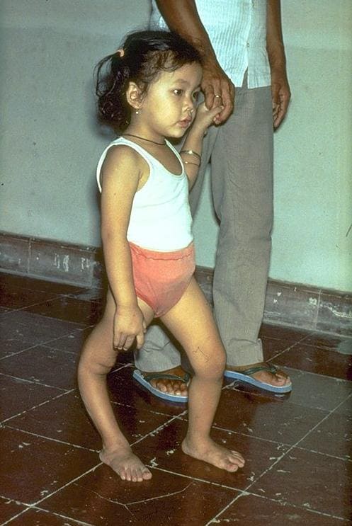 Фото ребенка, перенесшего полиомиелит