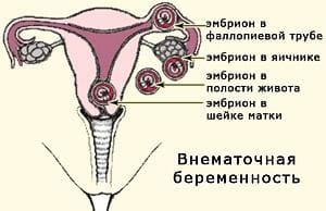расположения эмбриона при внематочной беременности