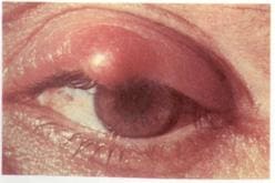 Фото симптомы ячменя на верхнем веке глаза