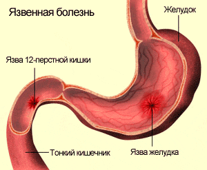 Язва (язвенная болезнь) желудка и двенадцатиперстной кишки