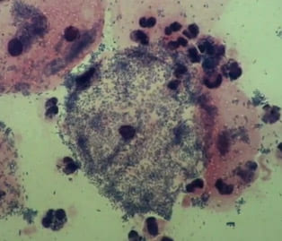 Бактериальный вагиноз под микроскопом. Облако в центре - ключевые клетки