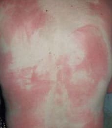Фото симптомов солнечных ожогов, фотодерматита