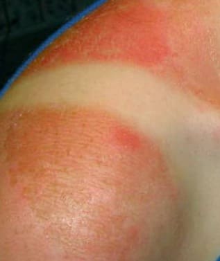Фото симптомов солнечных ожогов: гиперемия, пузыри