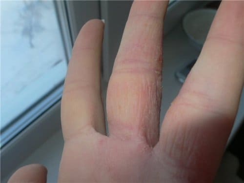 Симптомы дерматита от ношения кольца