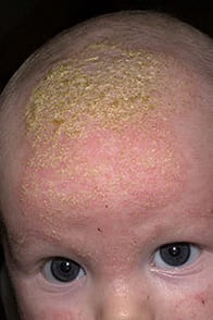 На фото симптомы себорейного дерматита у ребенка: молочный струп на волосистой части головы