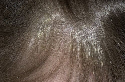 Фото: симптомы псориаза волосистой части головы