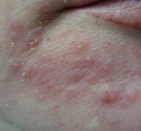 Фото Розацеаподобный дерматит (периоральный дерматит, стероидный дерматит, дерматит стюардесс)