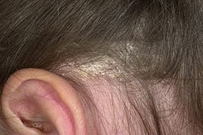 На фото симптомы себорейного дерматита волосистой части головы