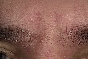 На фото симптомы себорейного дерматита лица